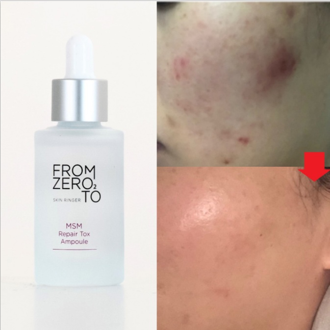 FROM ZERO TO сыворотка ANTIAGE ZERO2 Ампульная сыворотка направлена на устранение возрастных изменений и укрепление кожной матрицы с микроиглами 35 мл/MSM Repair ToxAmpoule(35ml EA) для лица 35 мл